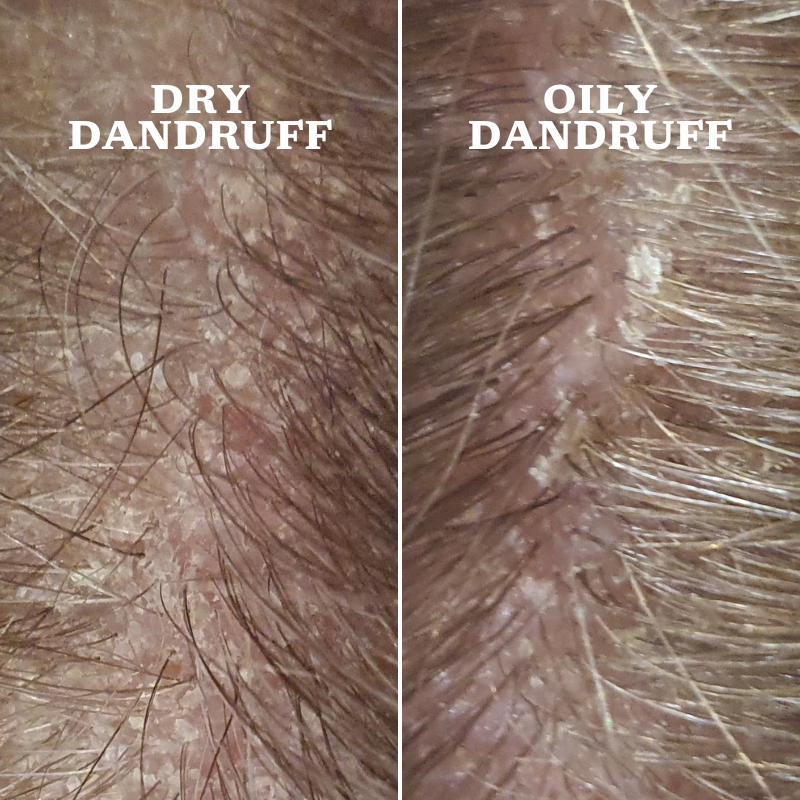 Dry or Oily Dandruff