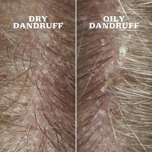 Dry on left & Oily Dandruff on right Scalp images