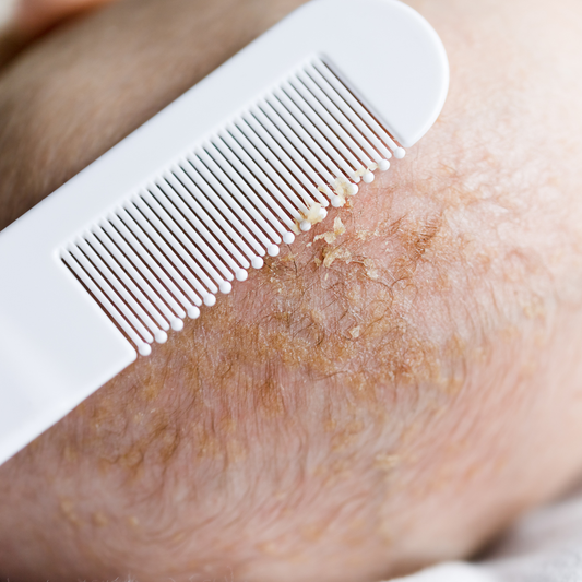 Cradle Cap