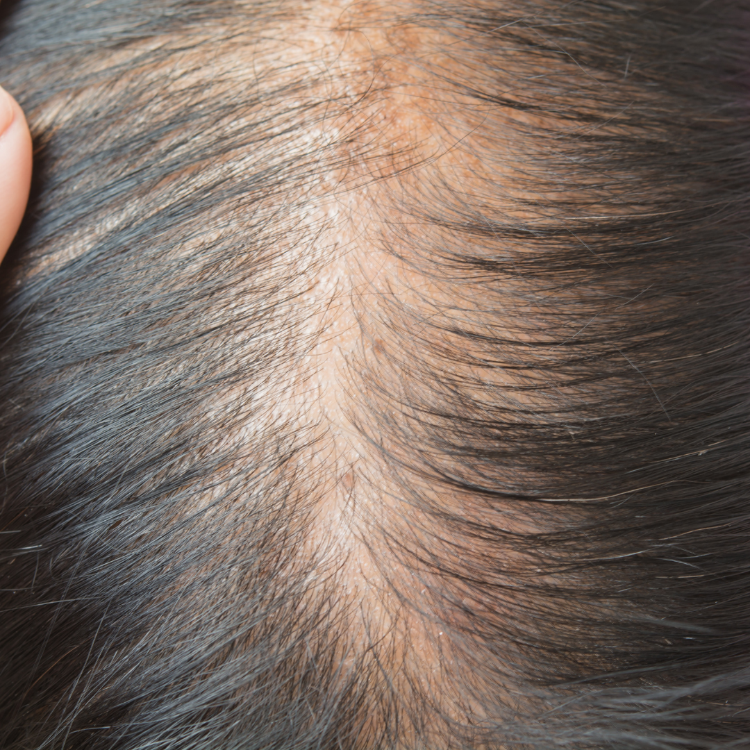 Hair Thinning and Shedding