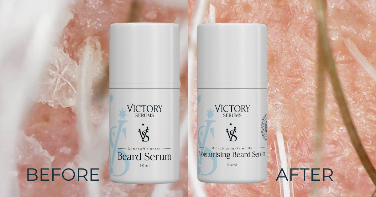 Beard Dandruff Duo - The Ultimate Solution