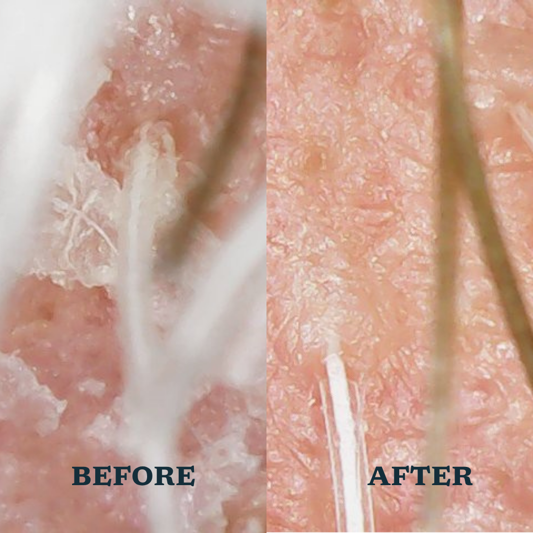 Dandruff Control Intensive Scalp Serum