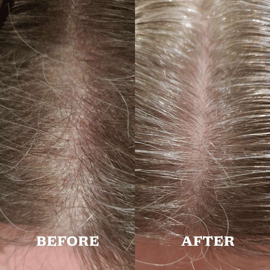 Before and after comparison of scalp and hair texture.