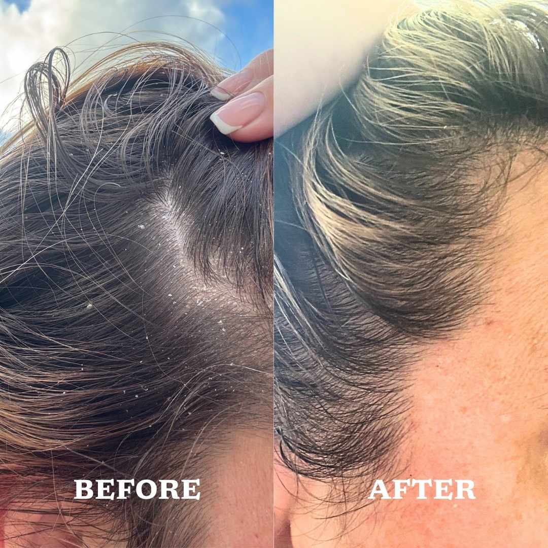 Before and after comparison of hair care treatment on a person's scalp.